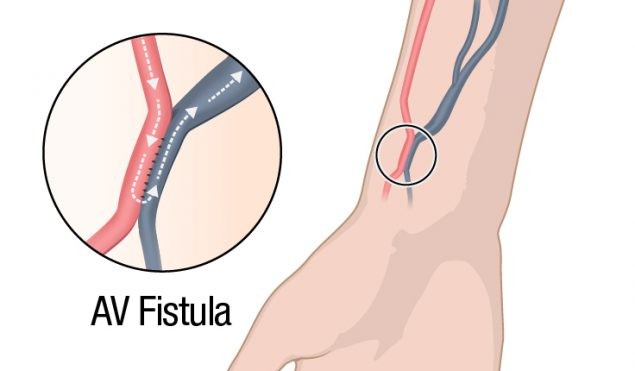 AV Fistuloplasty / Dialysis Access Salvage