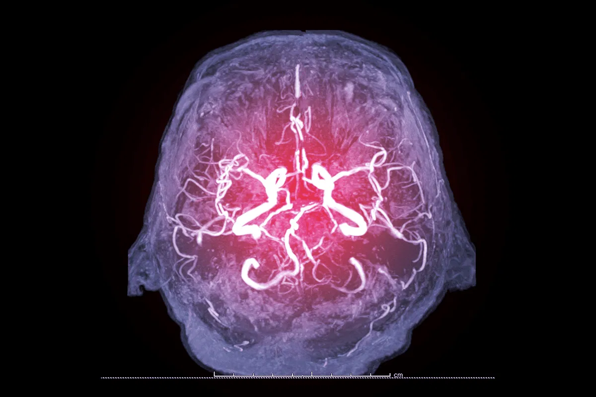 Carotid / Cerebrovascular Interventions