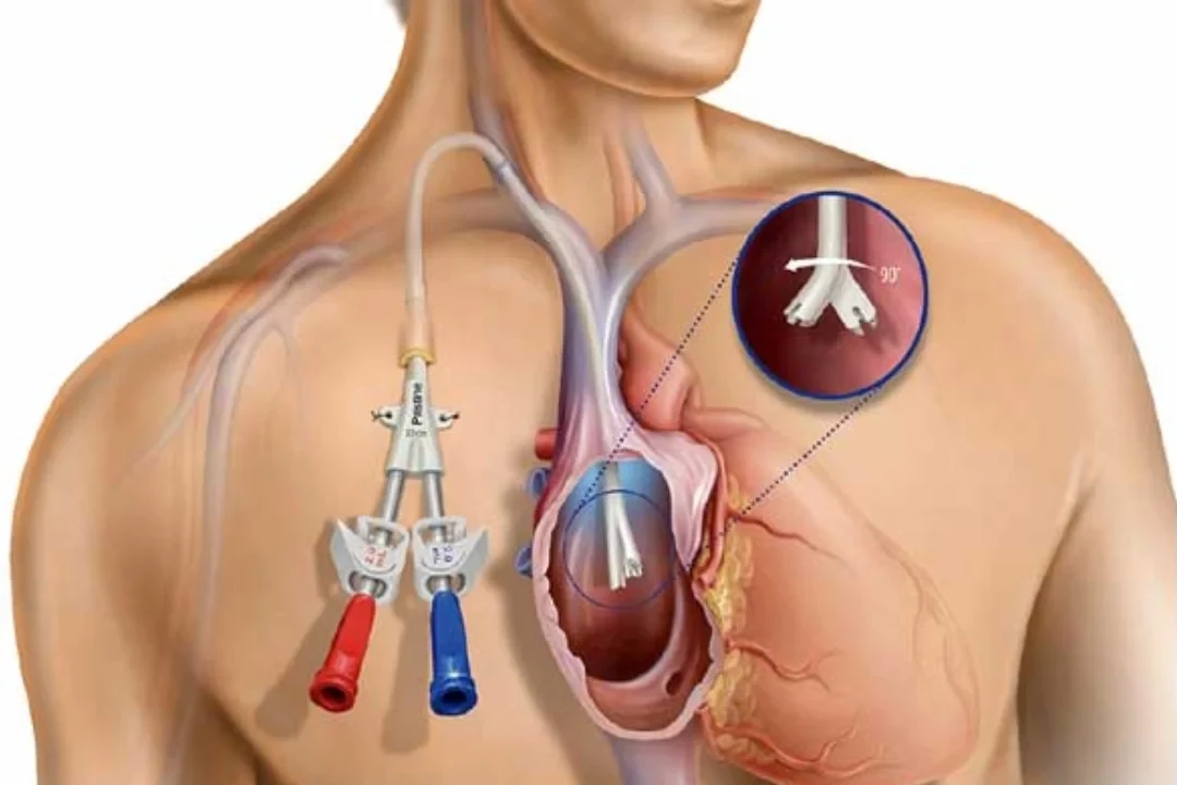 Catheter Placements