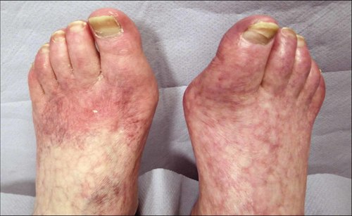 Critical Limb Ischemia Management