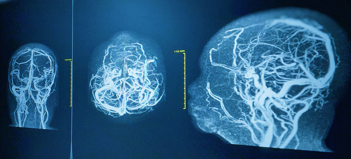 Diagnostic Cerebral Angiography
