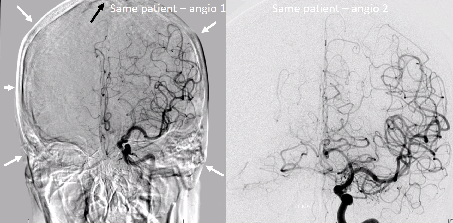 Diagnostic Cerebral Angiography in Bhuj
