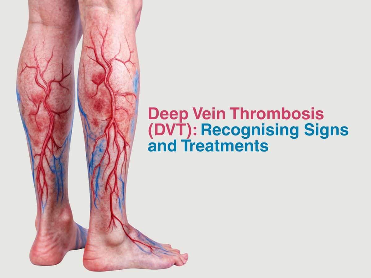 DVT Management
