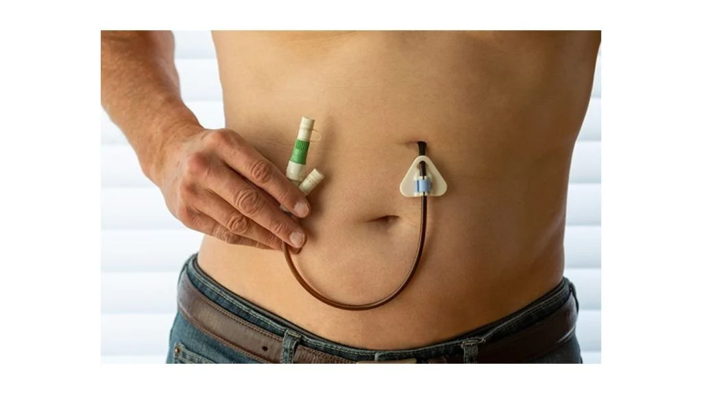 Gastrostomy