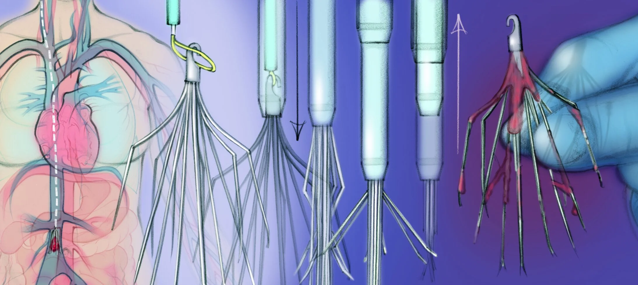 IVC Filter Placement & Retrieval