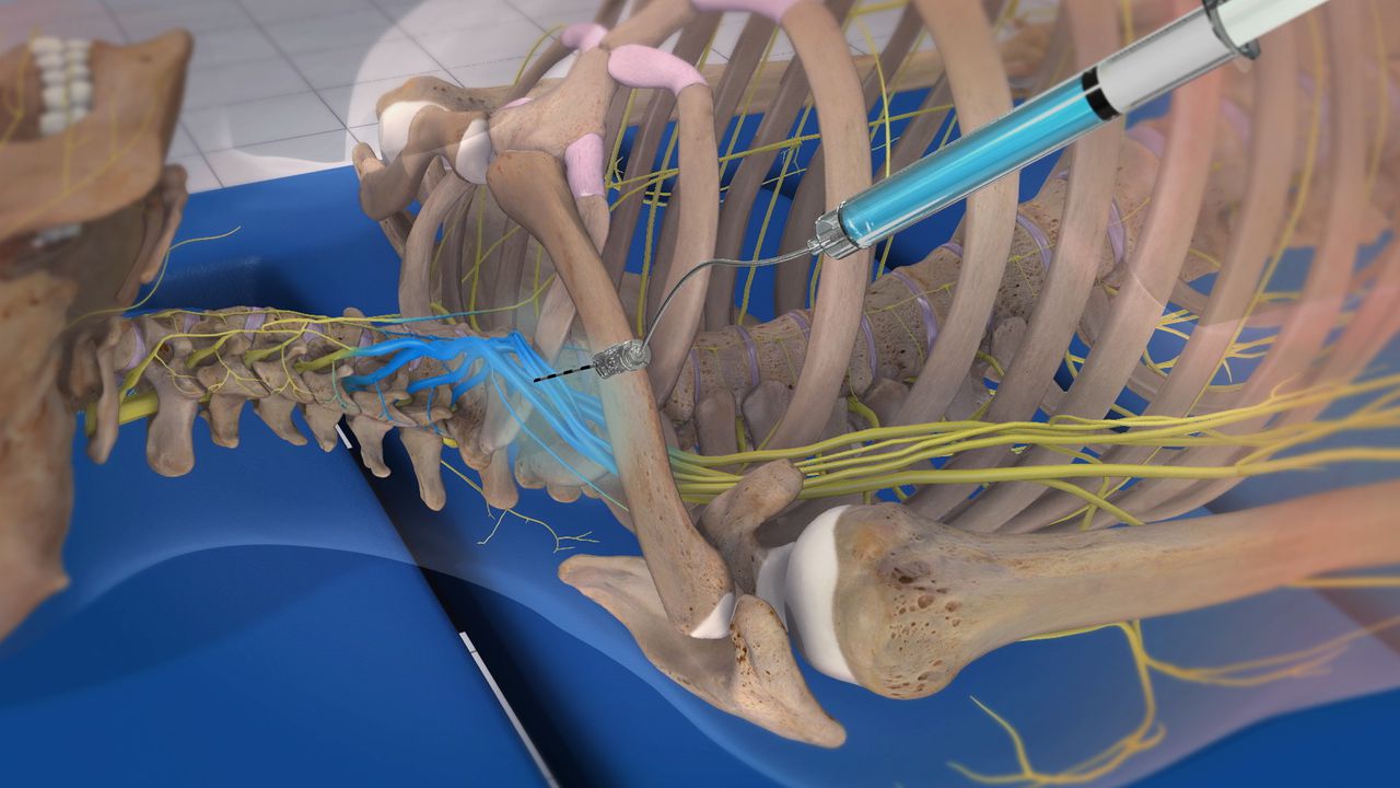 Nerve Blocks