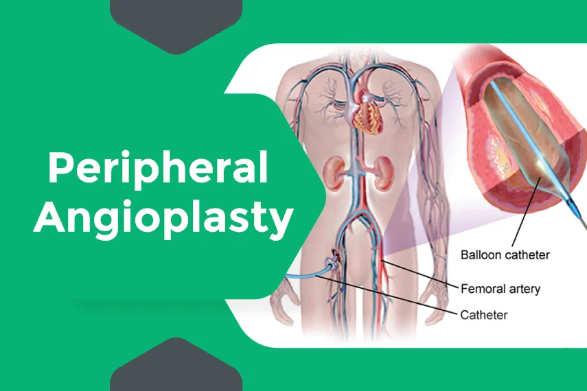 Peripheral Angiography & Angioplasty