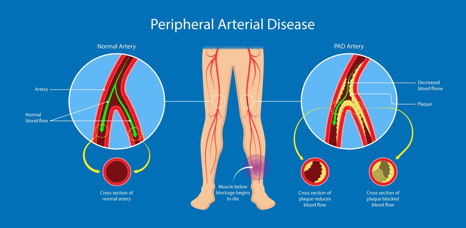 Peripheral Arterial Disease Treatment