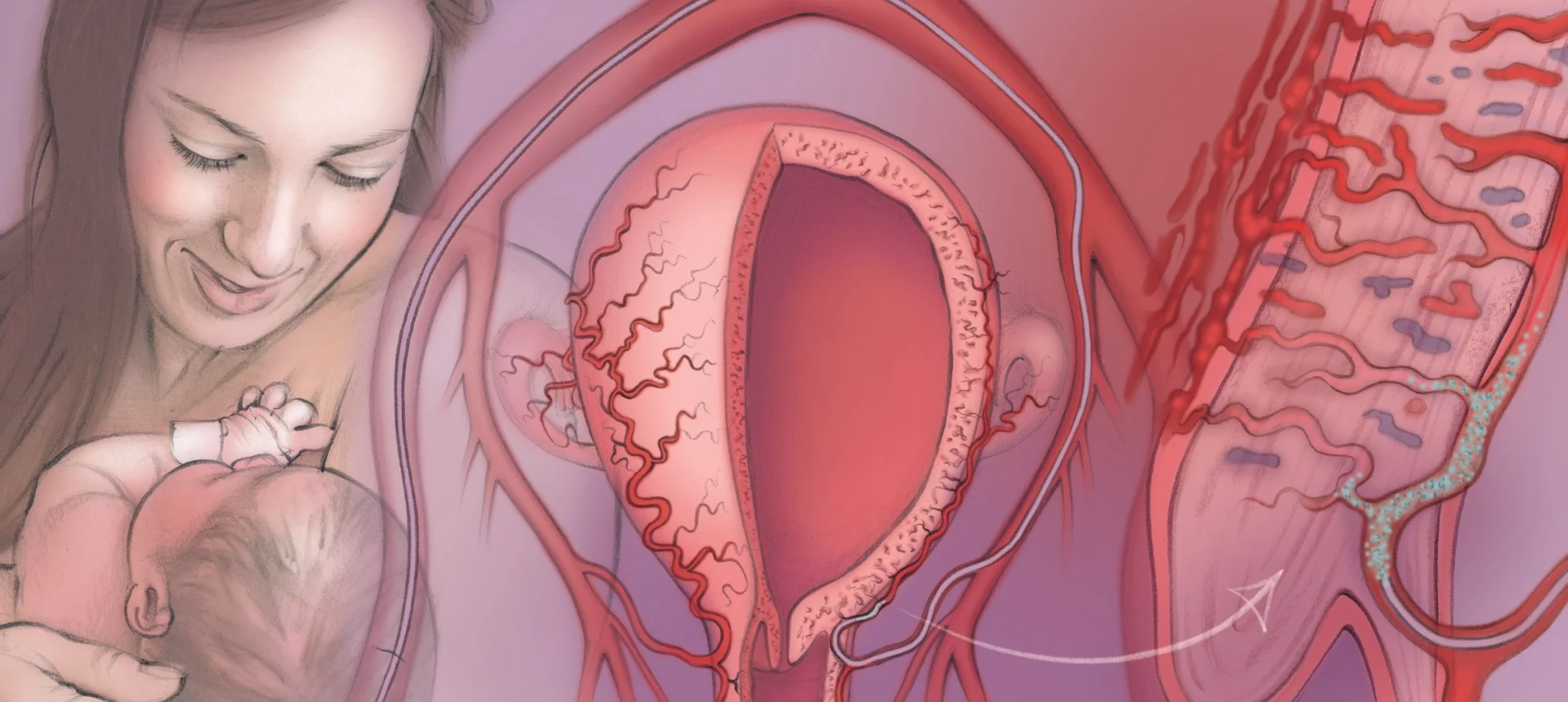 Postpartum Hemorrhage Embolization