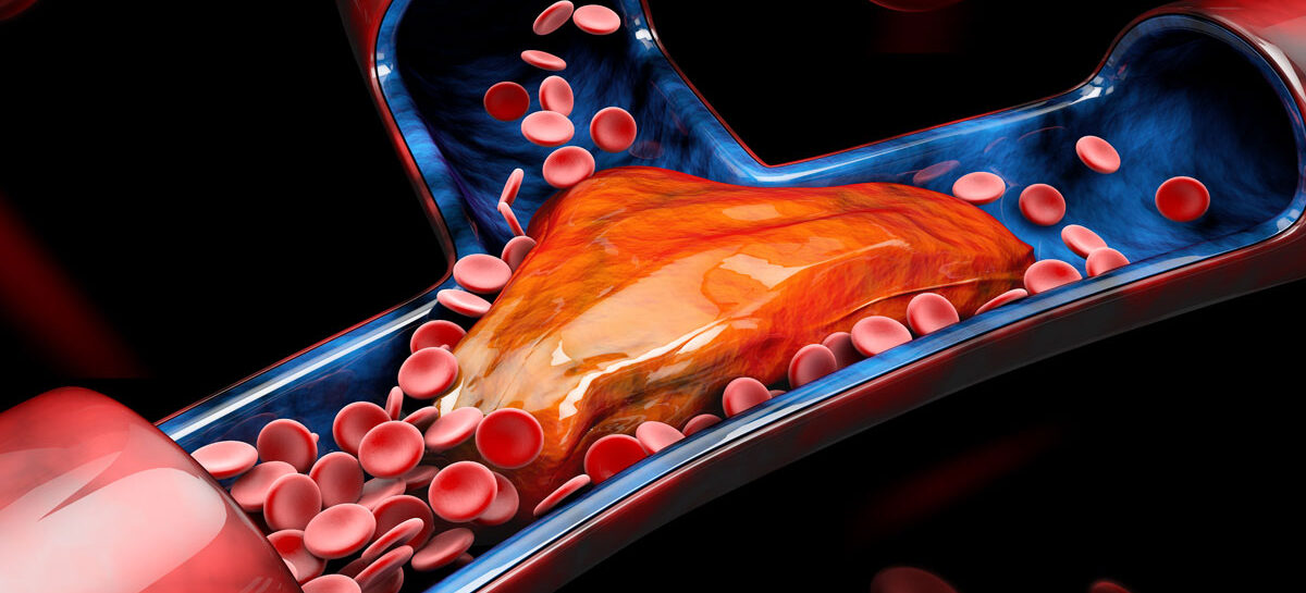 Thrombolysis / Thrombectomy