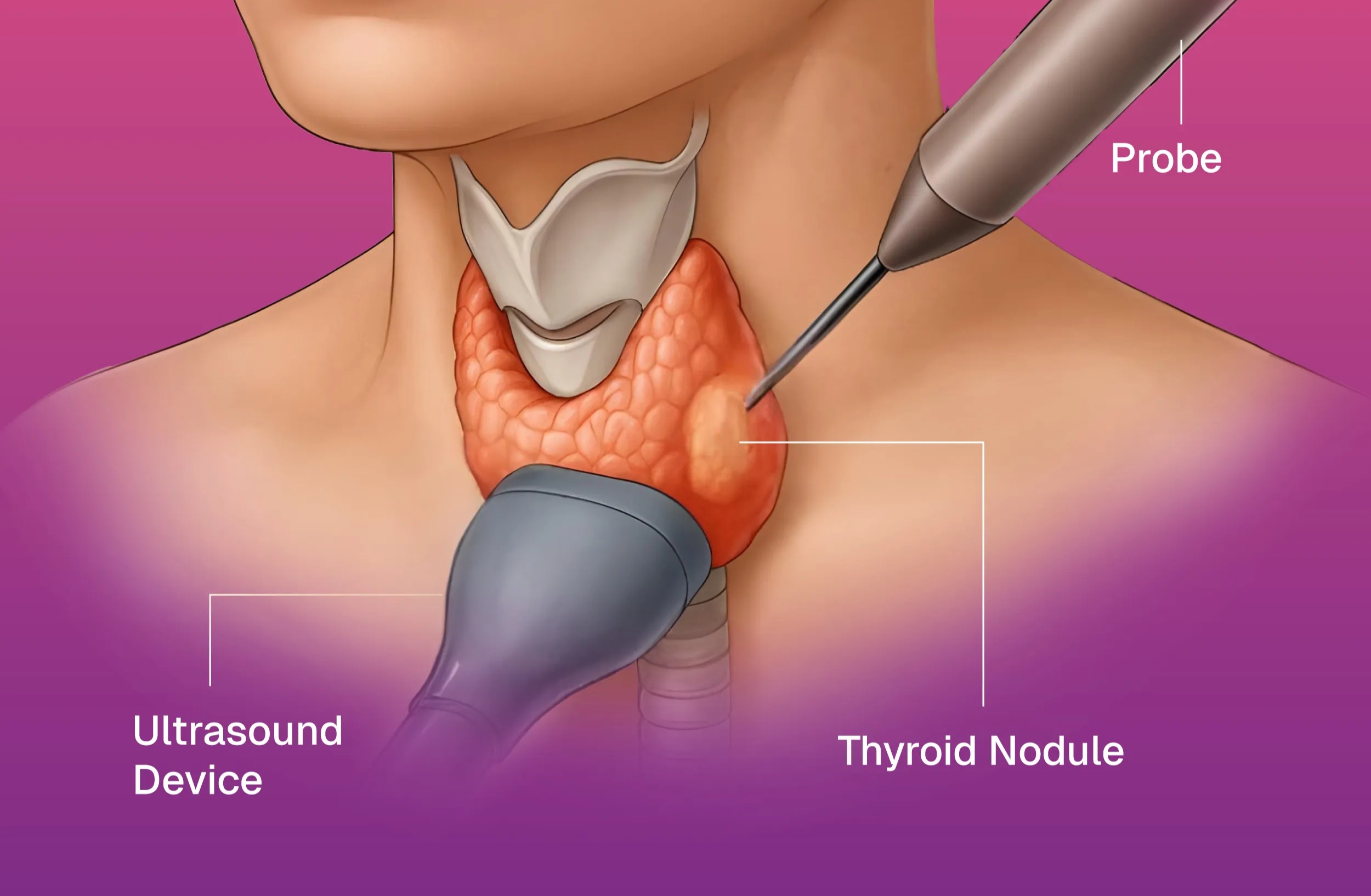 Thyroid Nodule Interventional in Bhuj