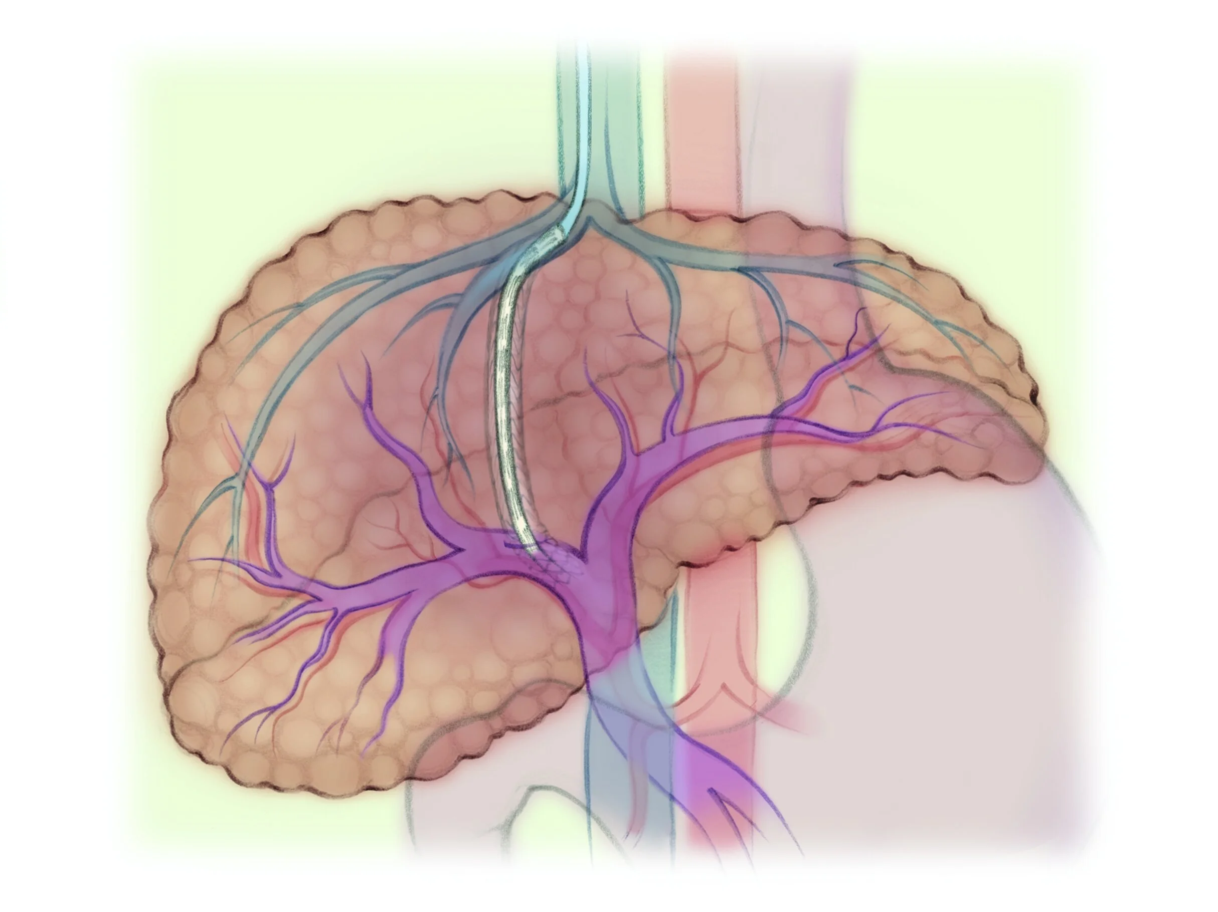 Transjugular Intrahepatic Portosystemic Shunt (TIPS)