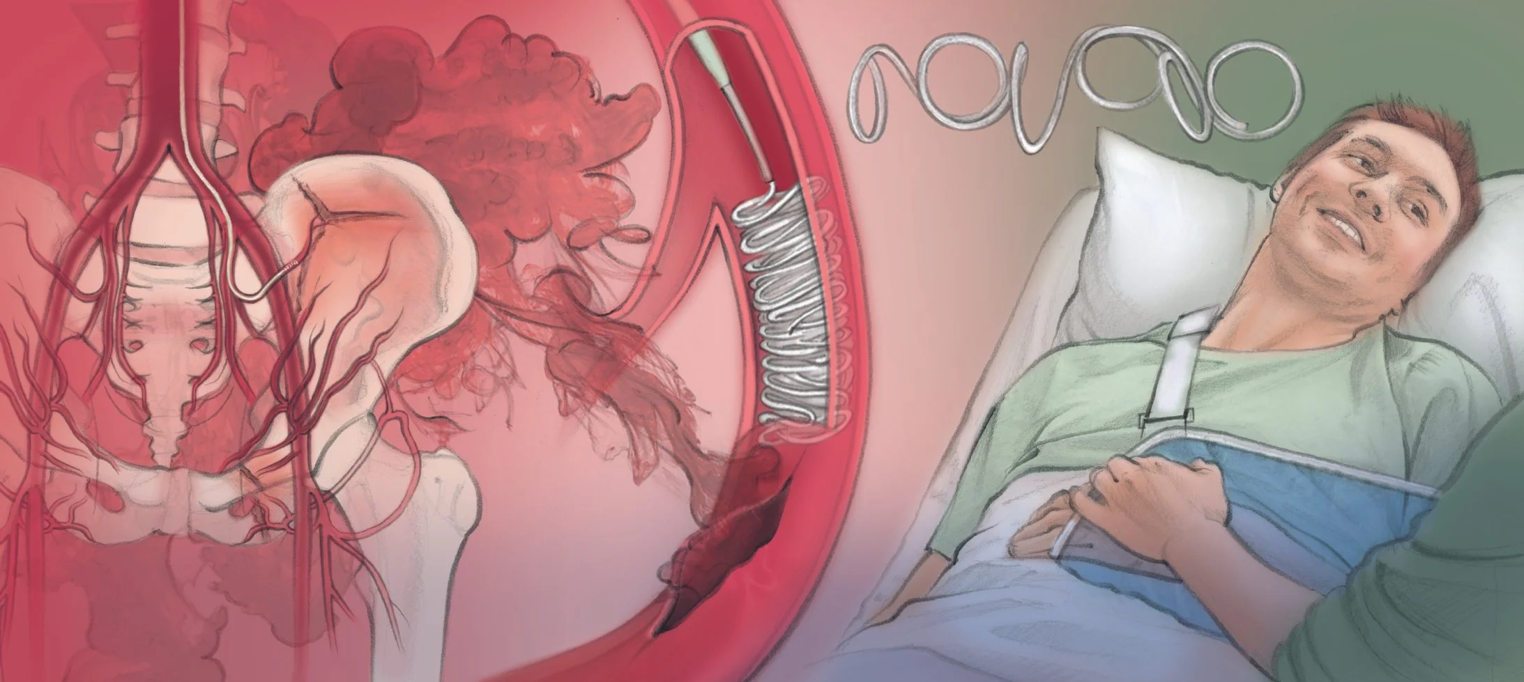 Trauma Embolization