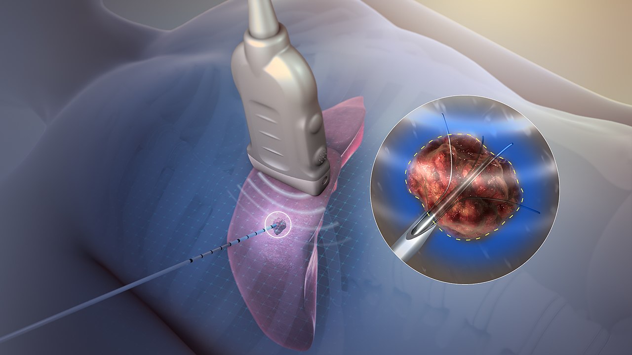 Tumor Ablation (RFA / Microwave)