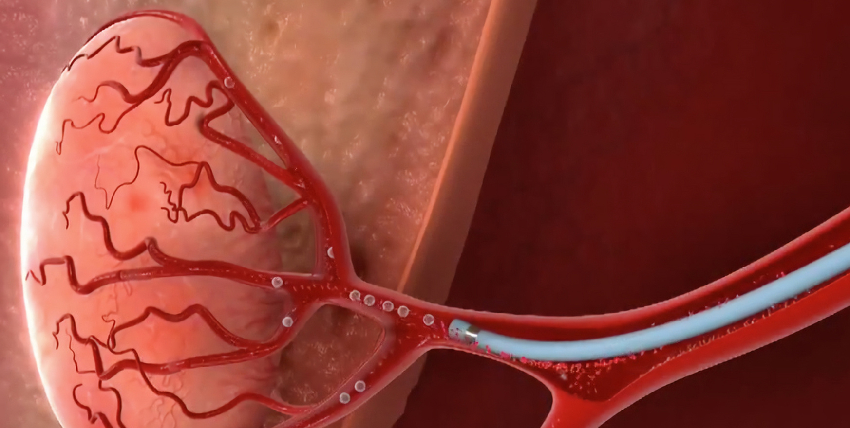 Tumor Embolization