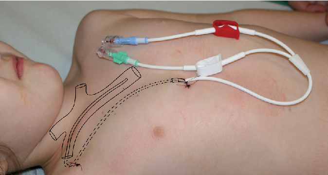 Tunneled Line / Central Venous Access