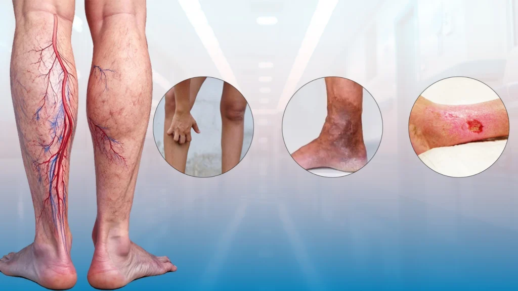 Varicose Vein Interventions
